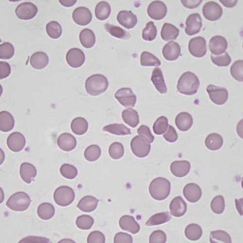Hemácias em foice | Banco de imagens hematologia