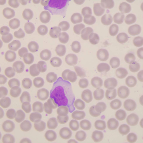 Linfócitos reativos | Banco de imagens hematologia