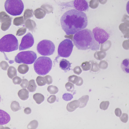 Leucemias | Banco de imagens hematologia