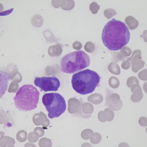 Mieloma múltiplo | Banco de imagens hematologia