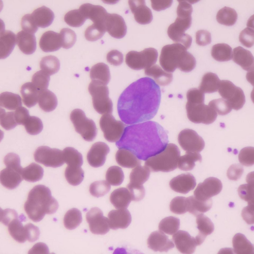2 Blastos | Banco de imagens hematologia