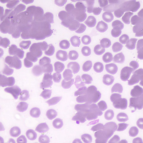 Crioaglutininas | Banco de imagens hematologia