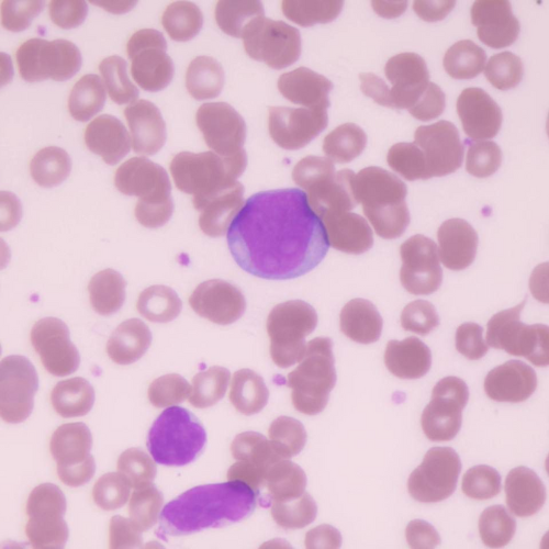 Leucemias | Banco de imagens hematologia