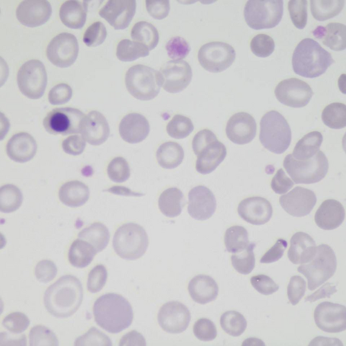 Eritroblasto ortocromático | Banco de imagens hematologia