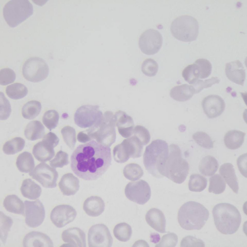 Neutrófilo hiperssegmentado e hemácias em alvo | Banco de imagens hematologia