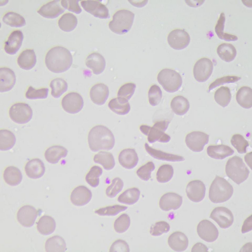 Hemácias em foice e hemácias cruzadas | Banco de imagens hematologia