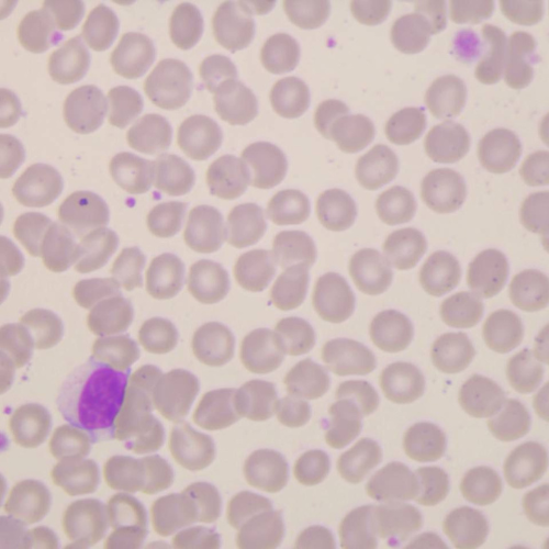 Linfócitos reativos | Banco de imagens hematologia