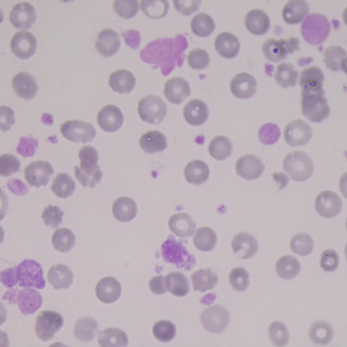 Macroplaquetas e plaquetas gigantes | Banco de imagens hematologia