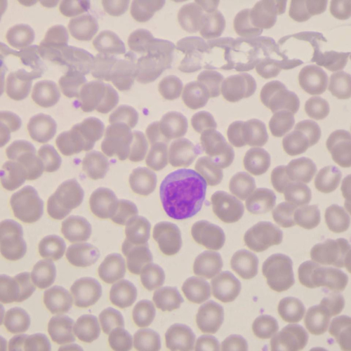 Linfócitos reativos | Banco de imagens hematologia