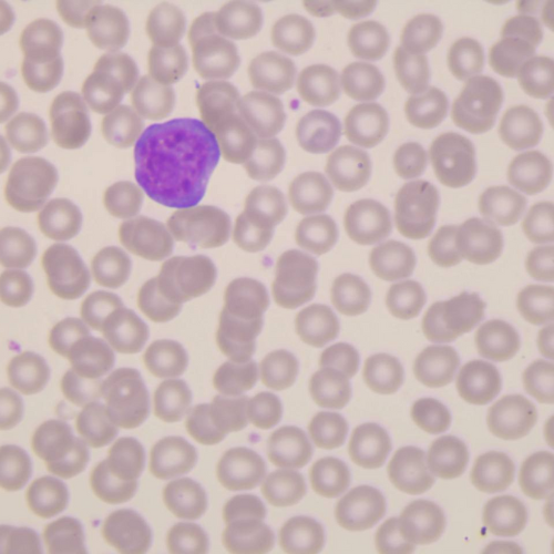 Linfócito reativo | Banco de imagens hematologia