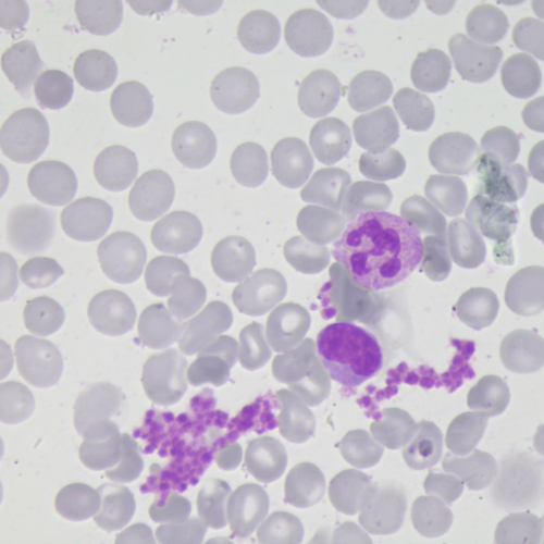 Agregação plaquetária induzida pelo EDTA | Banco de imagens hematologia