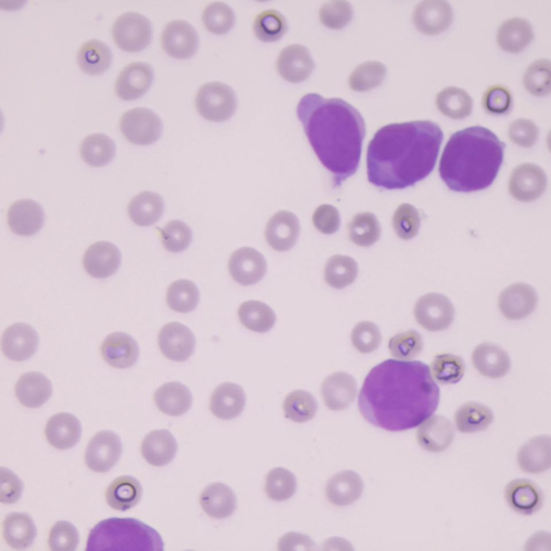 Leucemias