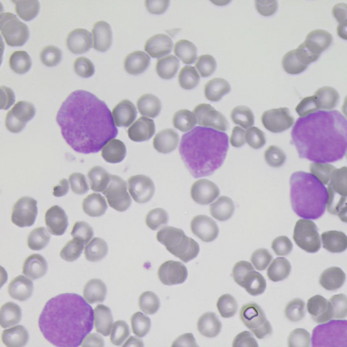 Leucemia promielocítica Hipergranular clássica, LPA com bastonetes de Auer