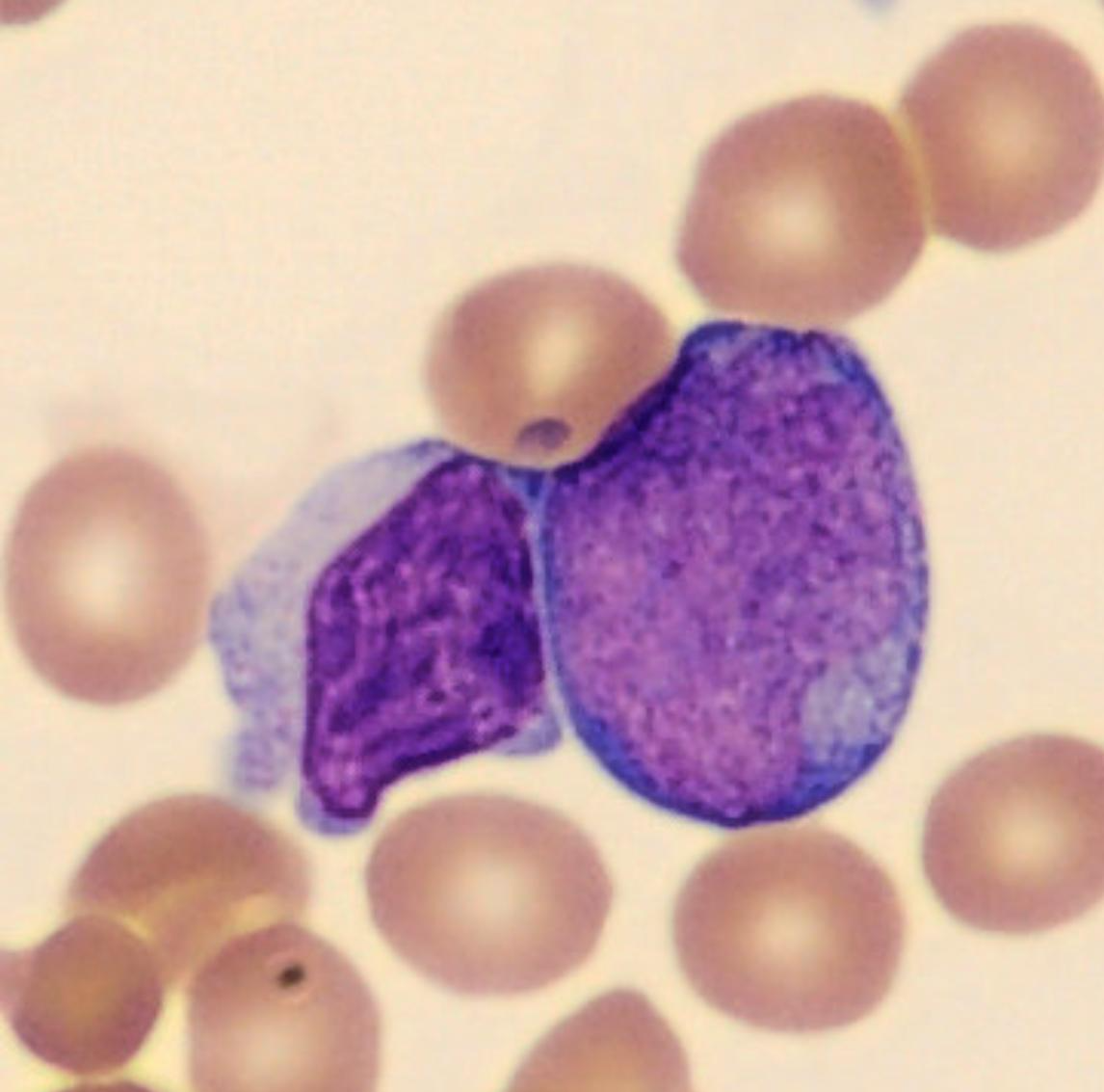 Blastos cup like | Banco de imagens hematologia