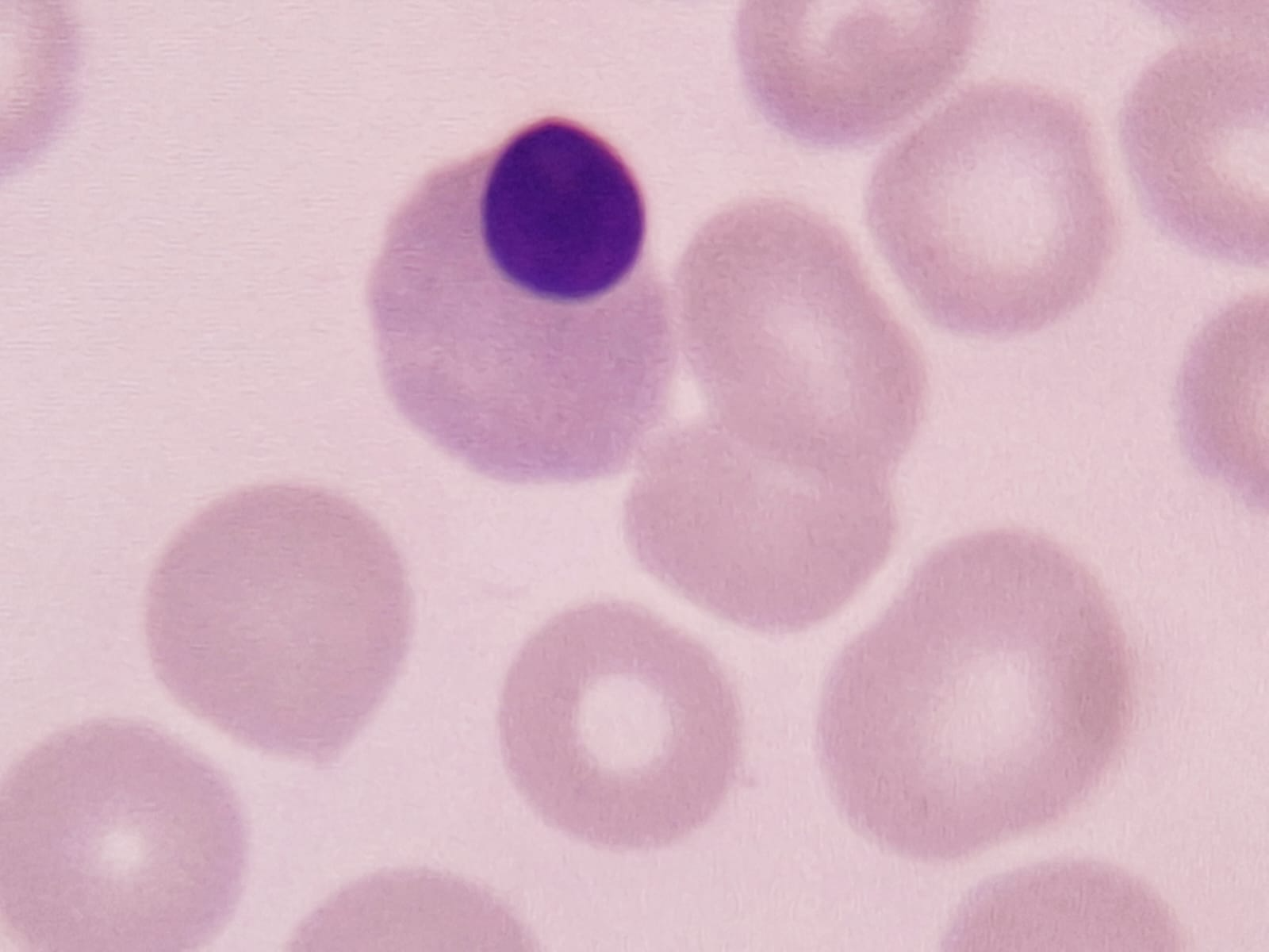 Eritroblasto | Banco de imagens hematologia