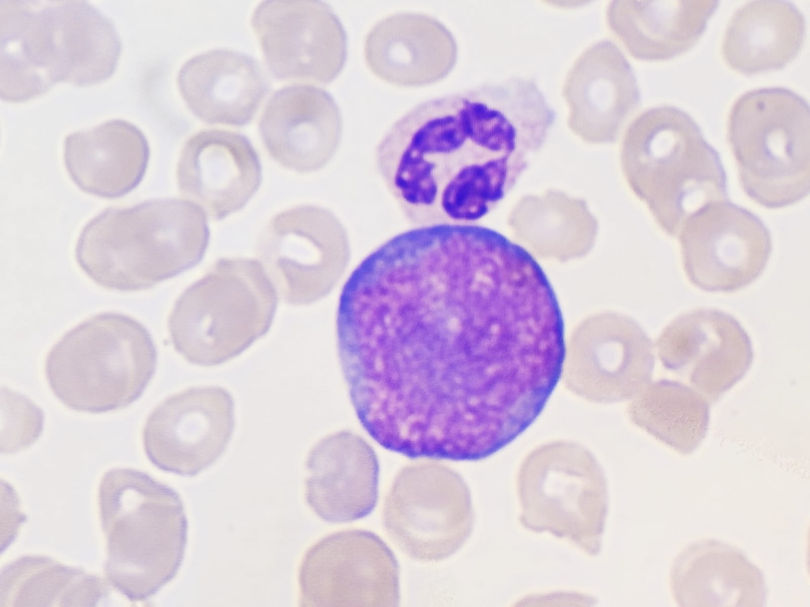 Blastos | Banco de imagens hematologia