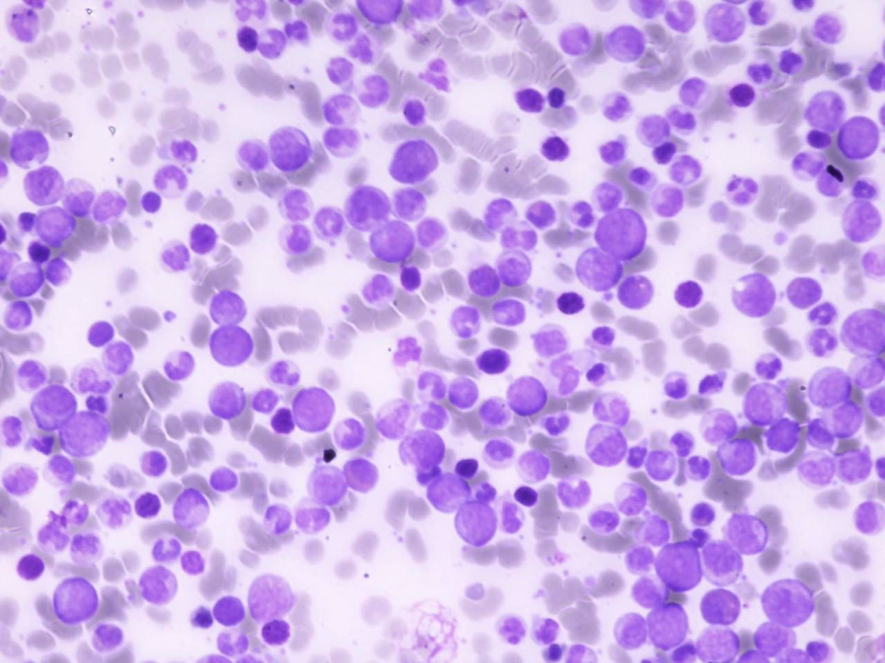 Leucemias | Banco de imagens hematologia