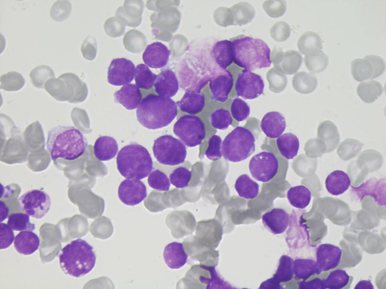 Leucemias blastos de pequeno a médio | Banco de imagens hematologia