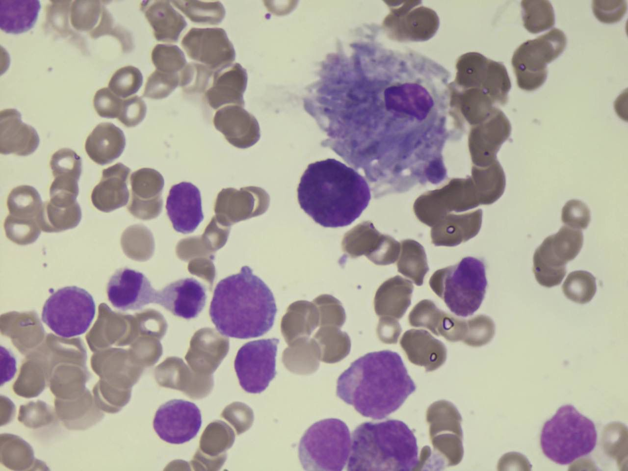 Leucemia mieloide crônica | Banco de imagens hematologia