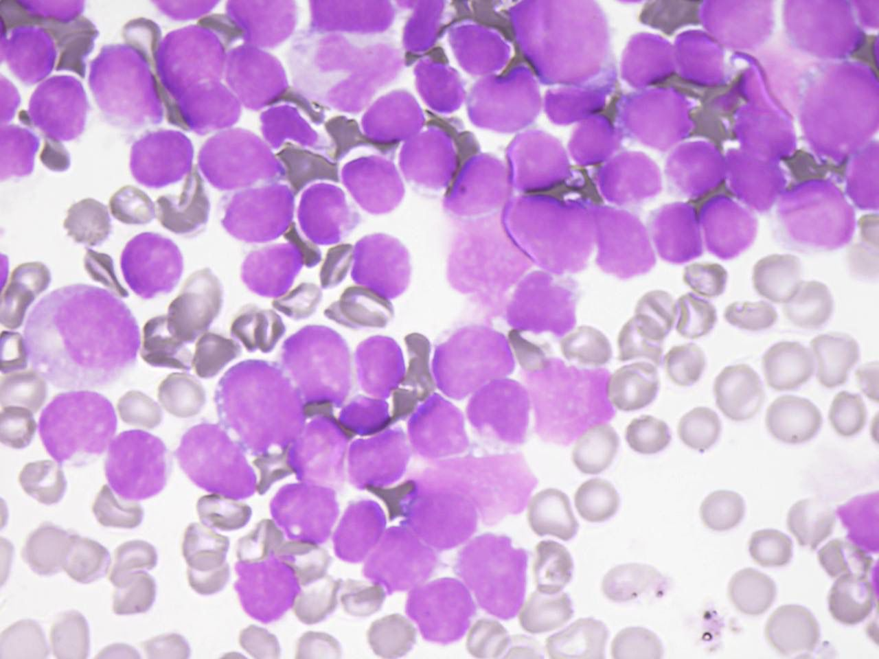 Leucemias | Banco de imagens hematologia
