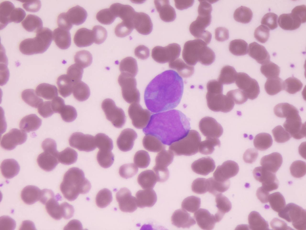 Leucemias | Banco de imagens hematologia
