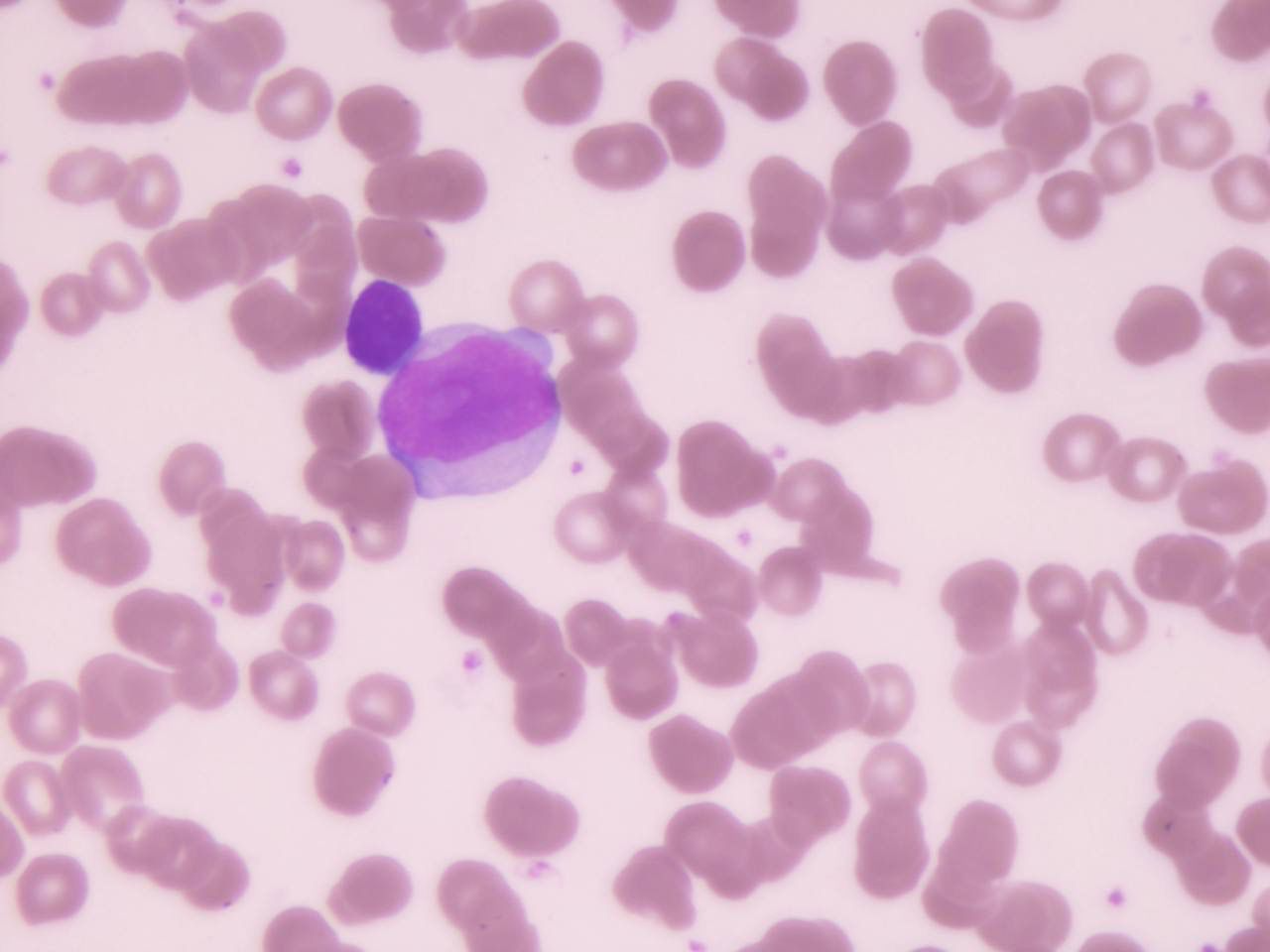 Leucemias | Banco de imagens hematologia