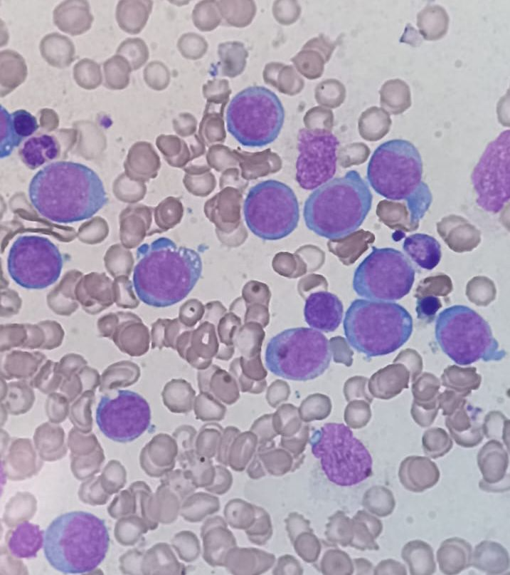 Blastos | Banco de imagens hematologia