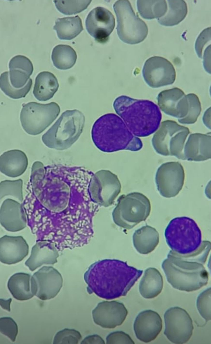 Blasto em espelho de mão | Banco de imagens hematologia