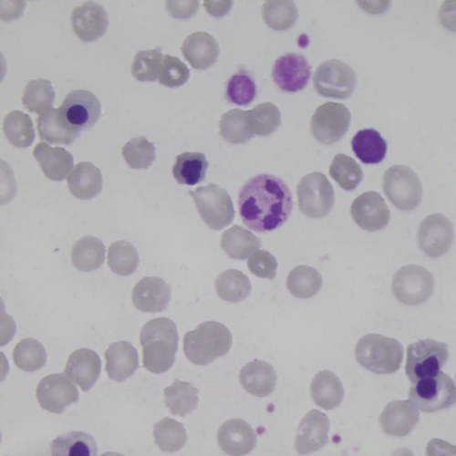 Numerosos eritroblastos ortocromaticos